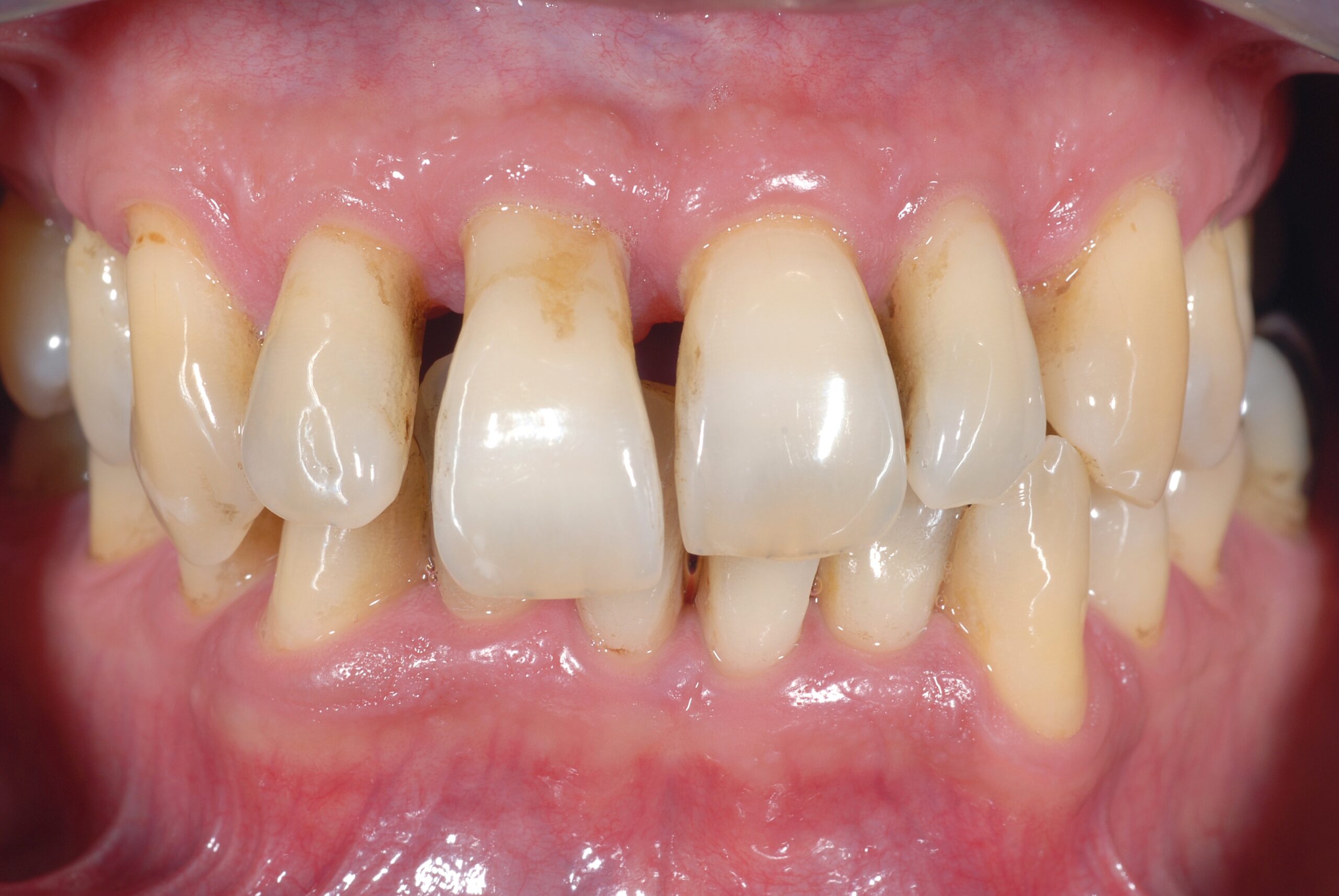 Devitalizzazione del dente che va incapsulato