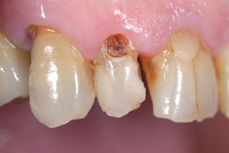 Elementi dentali distrutti da processi cariosi, perdita di oltre 50% tessuto coronale
