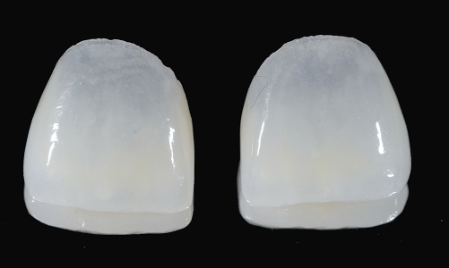 Faccette dentali in ceramica (Veneers)