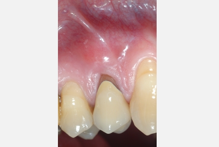 Granuloma in presenza di corona e perno moncone non rimovibili prima...