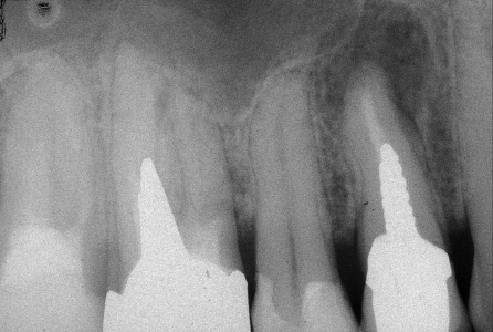 Granuloma in presenza di corona e perno moncone non rimovibili prima...