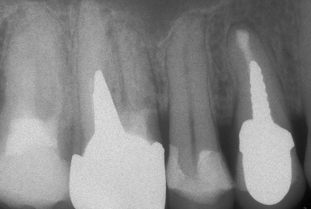 Apicectomia e otturazione retrograda dopo