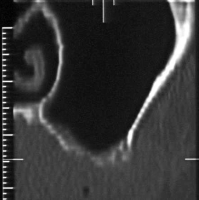 Seno mascellare con ridotto spessore di osso (inferiore a 2 mm)