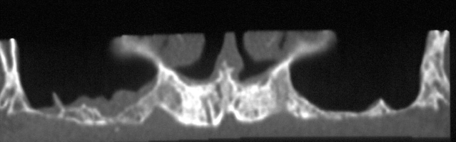 Seno mascellare pneumatizzato, ridotto volume di osso prima