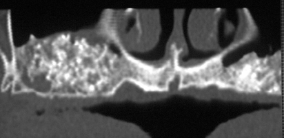 Rialzo di seno mascellare, aumentato volume di osso dopo: