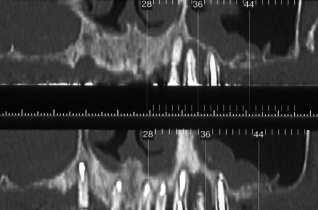 Una tomografia assiale computerizzata dà informazioni sulla presenza di una sinusite nel seno mascellare di destra