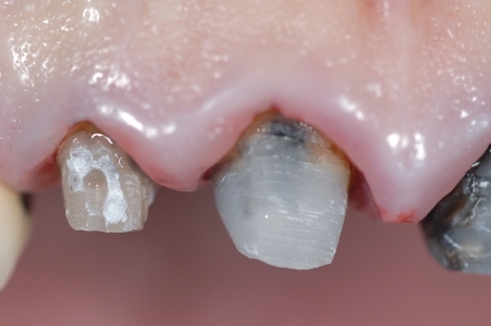 Lunghezza dei monconi dei denti prima…