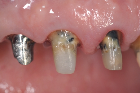 Lunghezza dei monconi dei denti dopo…