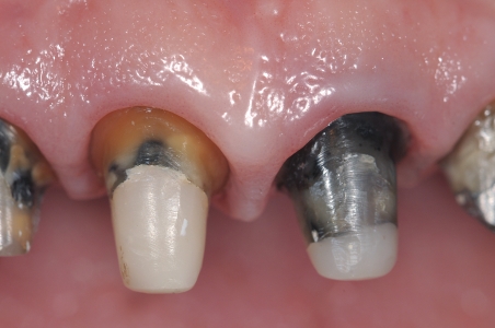 Lunghezza dei monconi dei denti dopo…