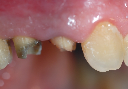 Chirurgia ossea resettiva: monconi corti dei denti, necessità di allungare, prima…