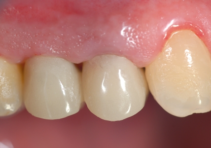 Chirurgia ossea resettiva: monconi corti dei denti, necessità di allungare, prima…