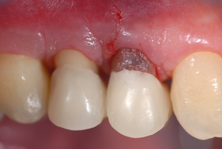 Chirurgia resettiva: monconi dei denti allungati dopo…