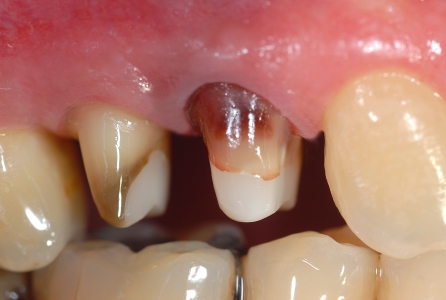 Chirurgia resettiva: monconi dei denti allungati dopo…