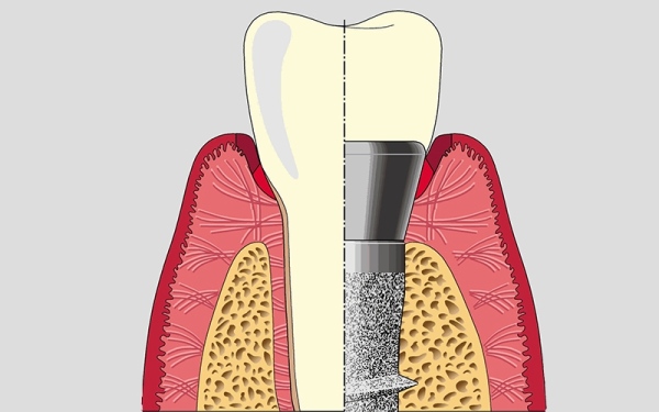 “Denti fissi in un solo giorno”. E’ possibile? Considerazioni