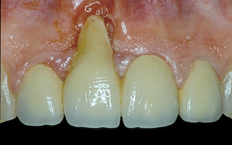 Falsi dentisti: 3 italiani su 4 conoscono i rischi ma ci vanno per risparmiare