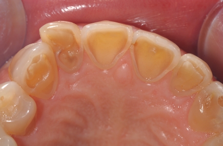 Errori più frequenti nell'esecuzione delle manovre di igiene orale