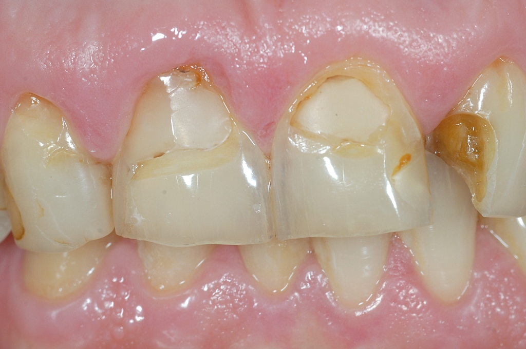 Faccette e otturazioni nei denti frontali