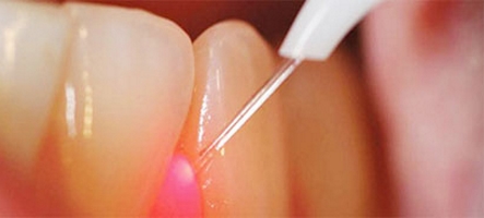 Il laser per curare piorrea e malattie parodontali. Realtà o mito?