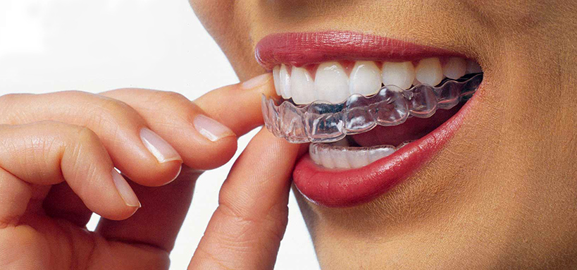 Ortodonzia Invisibile, Tecnica Invisalign