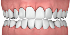 Affollamento dentale