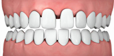 Spaziatura tra i denti (diastemi)