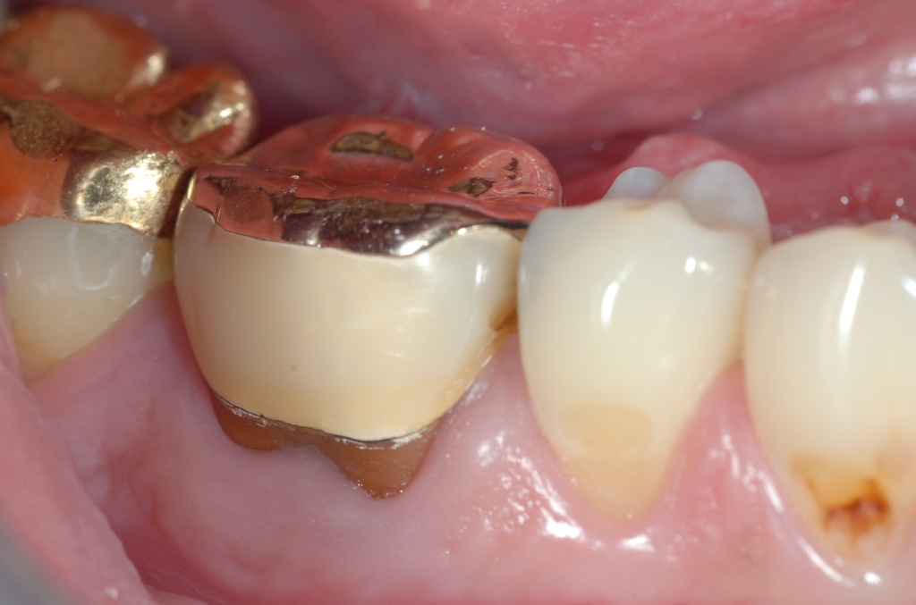 Situazione iniziale granuloma su molare devitalizzato ricostruito con perno moncone non trattabile