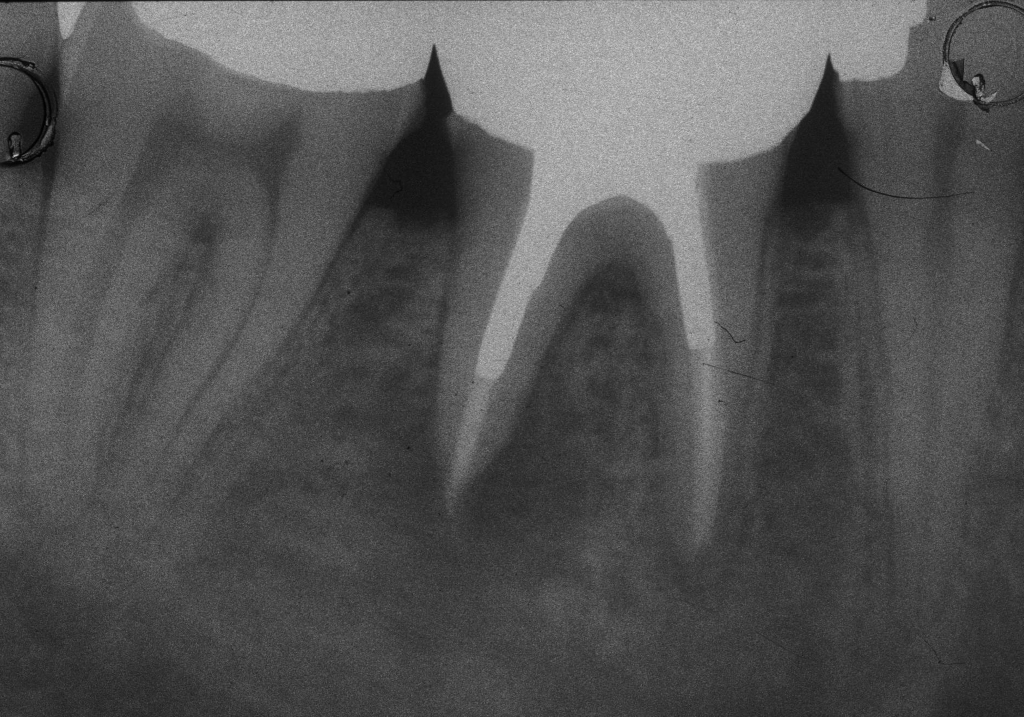 Perchè in un dente devitalizzato si può formare un granuloma?