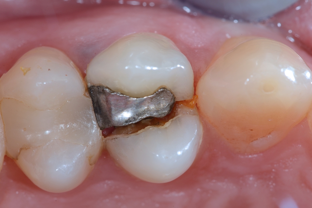 Un dente con una otturazione in “pasta d’argento” piccola si può fratturare?