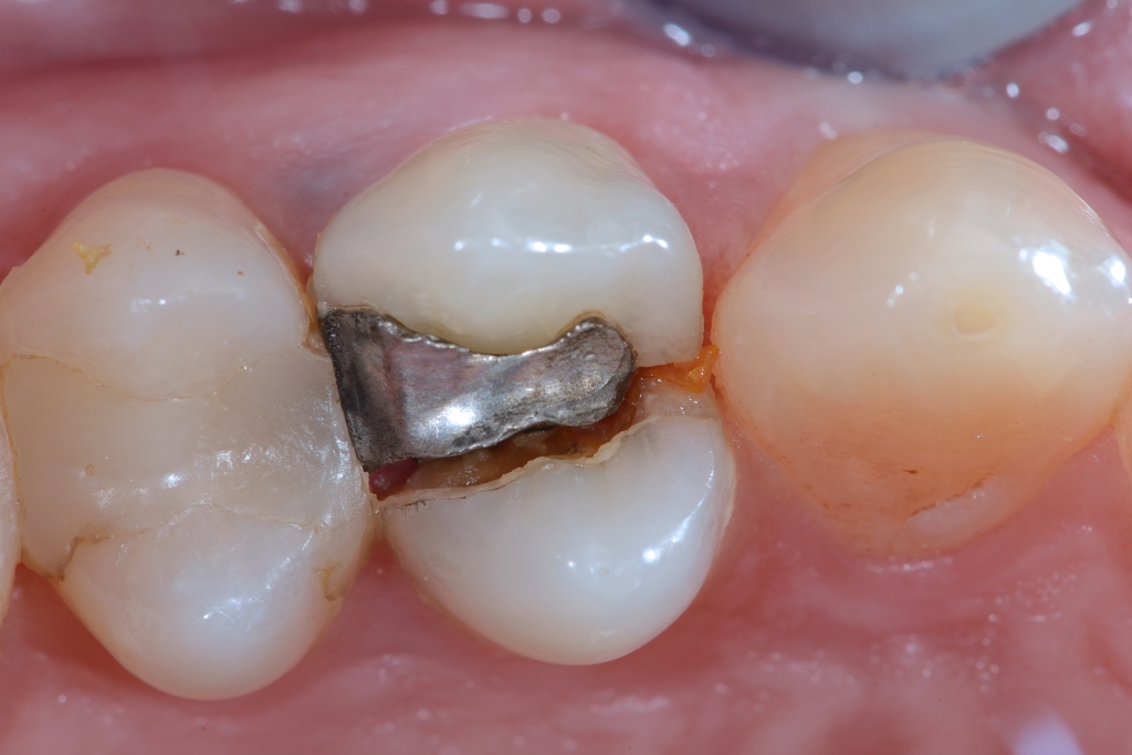 Frattura completa di premolare che presenta una otturazione in amalgama piccola (elemento non trattabile) …