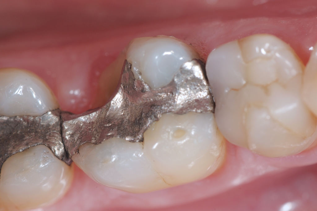 Perché un dente con una otturazione in “pasta d’argento” si può fratturare più facilmente?