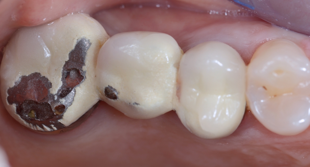 10 utili consigli per capire se la vostra corona protesica ha qualche problema