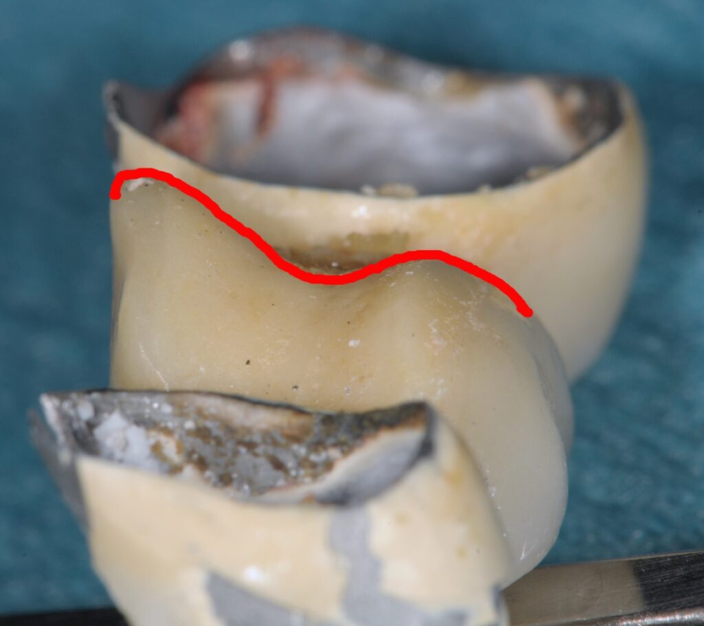 La linea rossa mette in evidenza l’andamento concavo di questa corona in metallo ceramica sospesa su una sella edentula. La concavità rende estremamente difficile se non impossibile mantenere un livello di igiene sufficiente.