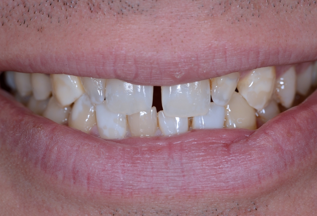 Elementi negativi che rendono il sorriso non particolarmente estetico (spazi neri tra i denti e discromie)