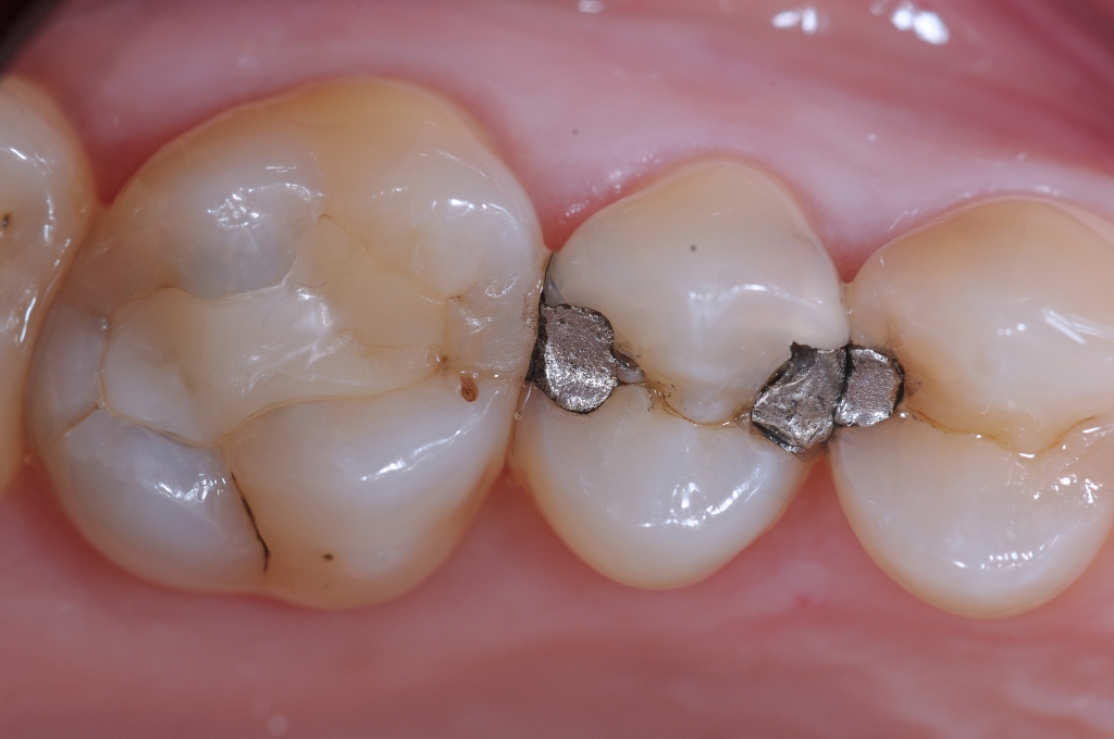 Situazione iniziale carie multiple a carico di diversi denti (quadrante)