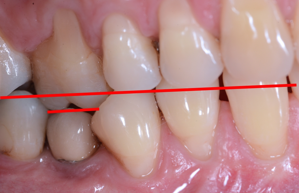 Impianto inserito in regione premolare quando il paziente non aveva ancora completato la crescita (notare intrusione della corona su impianto linea rossa breve indica dove si trova margine incisale, linea rossa lunga dove dovrebbe essere)