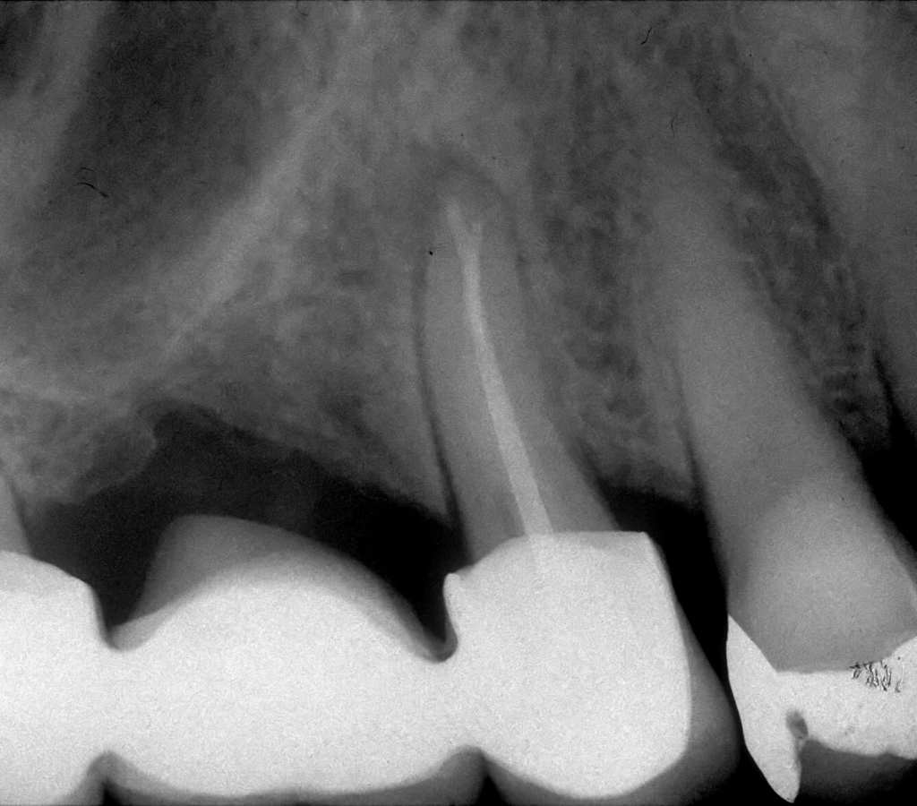 Radiografia di ponte con i classici margini di chiusura inesistenti a sombrero… 