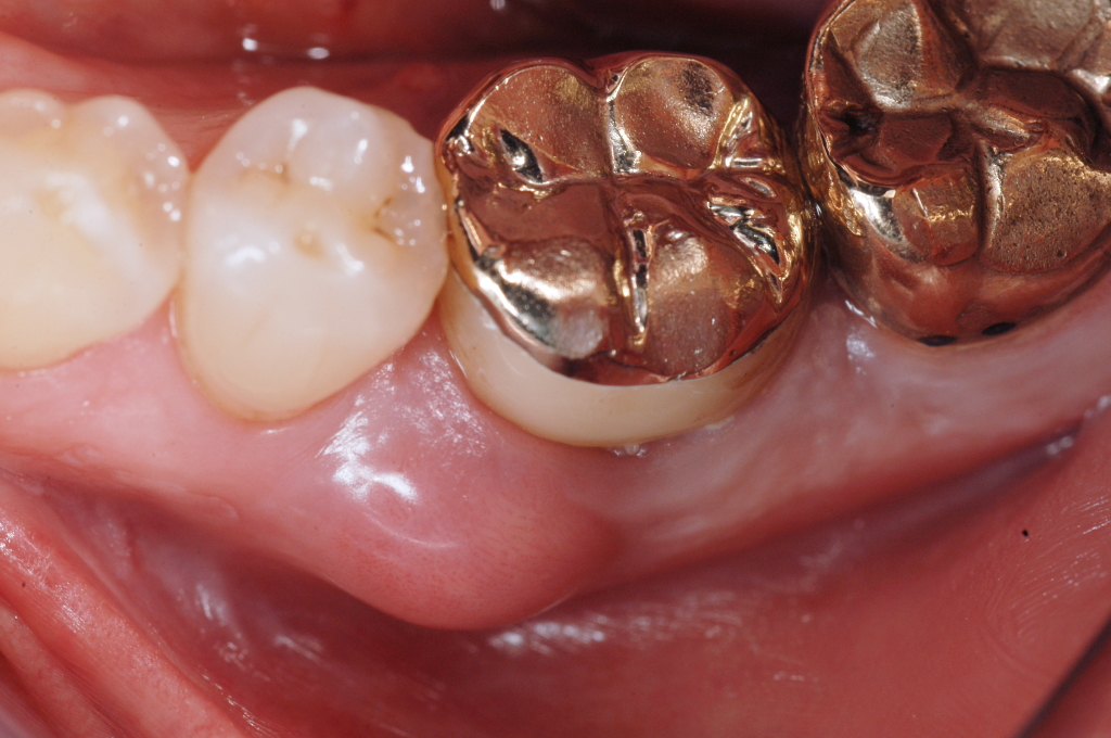 Cos’è una frattura a legno verde su un dente? Può essere trattata?